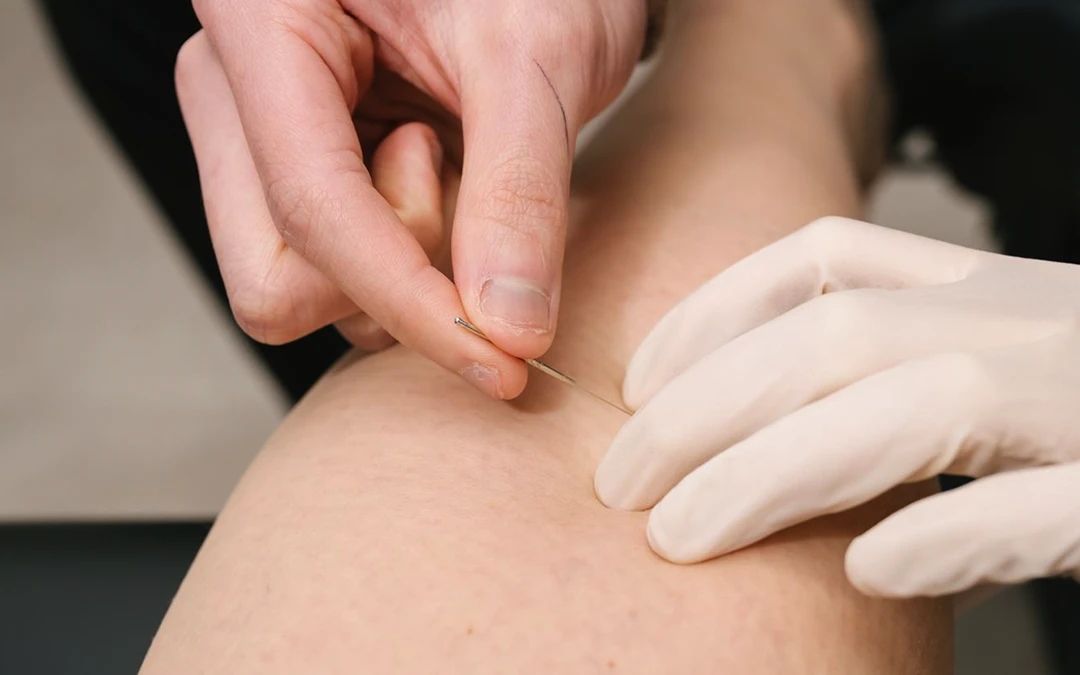 What is ‘Dry Needling’?