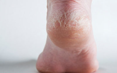 Summer Is Coming – Prevent Dry, Cracked & Bleeding Heels