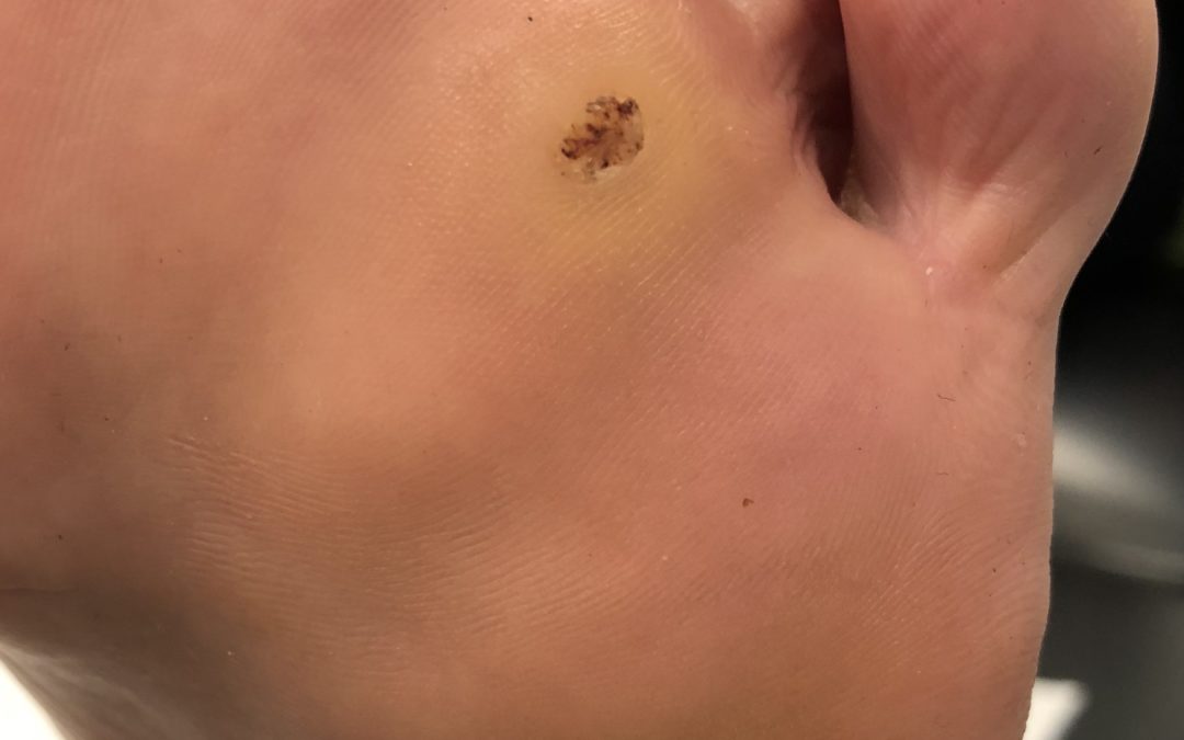 Podiatrist Caelin Talks All Things Warts & How We Can Eliminate Them