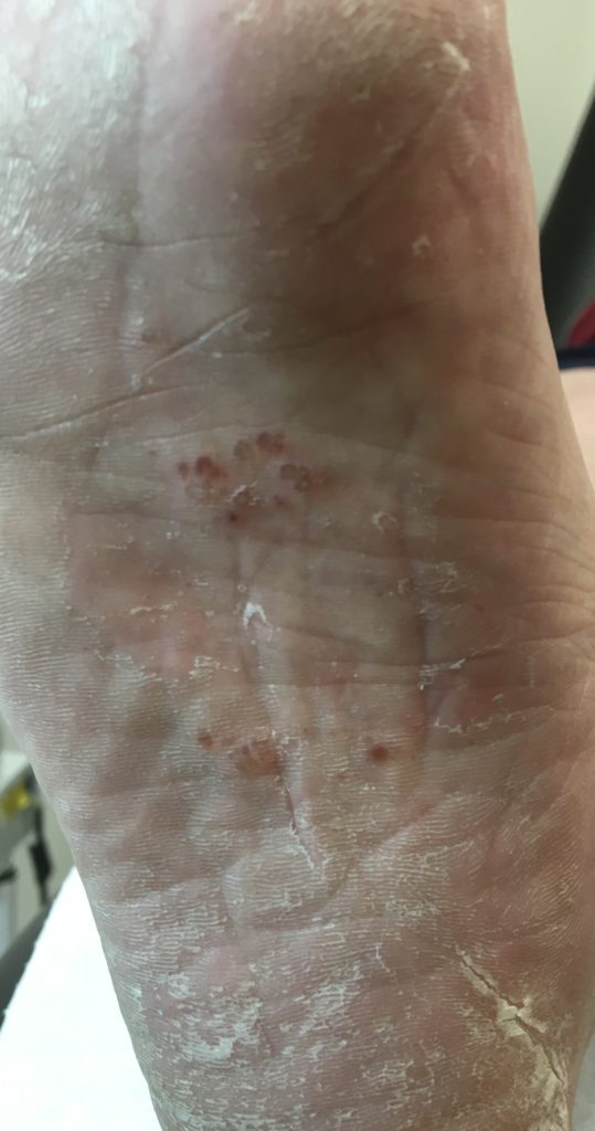 Why are my feet so itchy??? It could be tinea! Holistic Foot Clinic