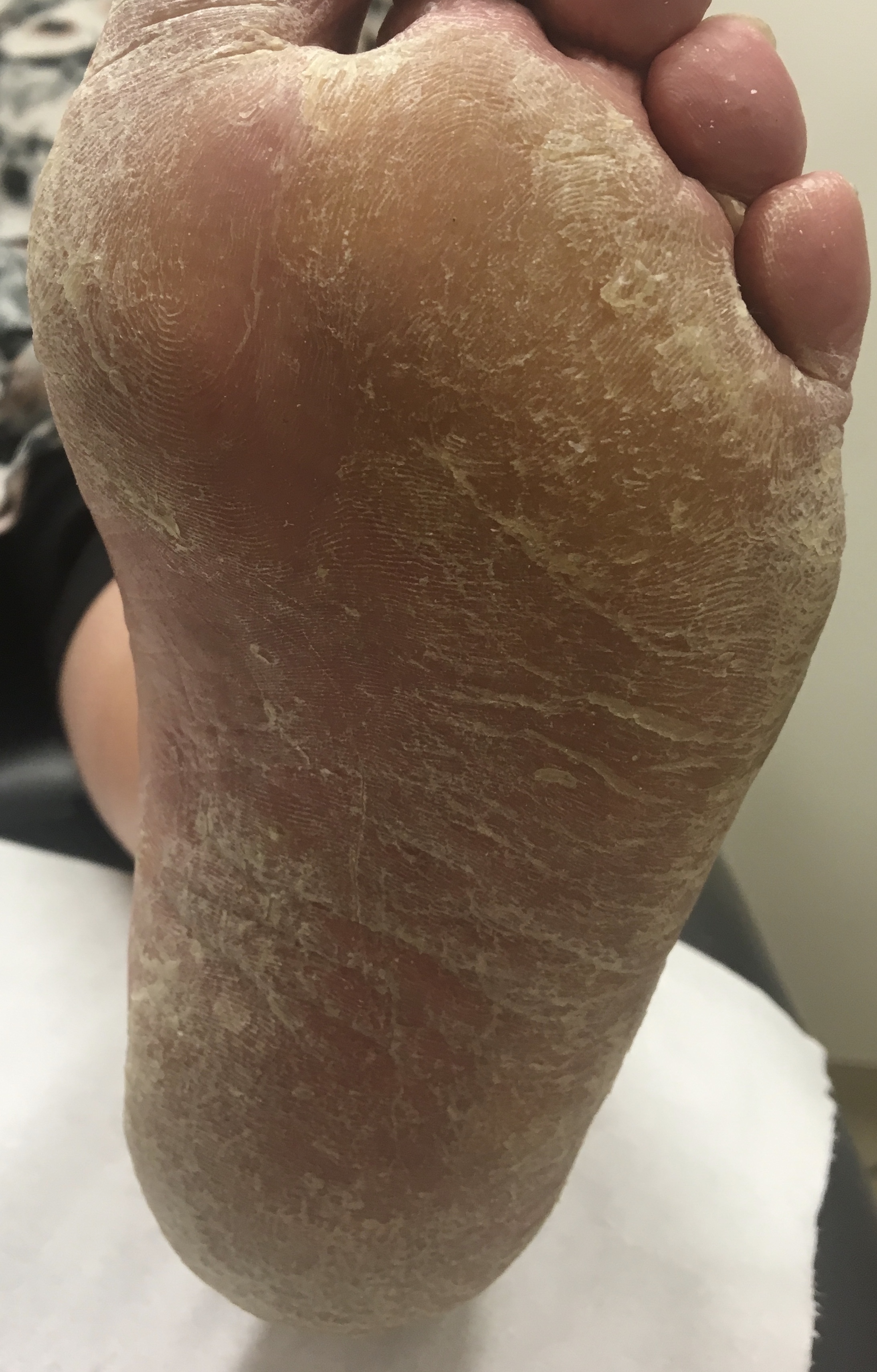 why-are-my-feet-so-itchy-it-could-be-tinea-holistic-foot-clinic