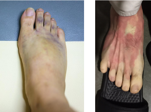 Chilblains & Raynaud’s Syndrome - Causes & Prevention Tips