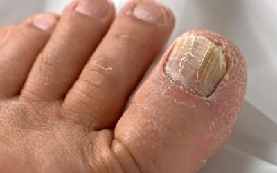 PACT Nail Fungus Therapy