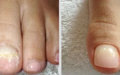 Introducing KeryFlex — A Natural-Looking Solution for Damaged Toenails