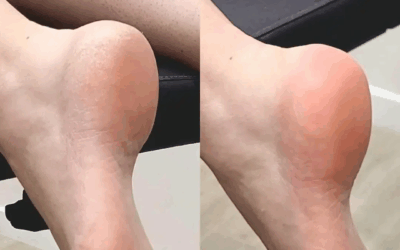 Summer Foot Care Tips: How to Keep Your Feet Healthy All Season Long